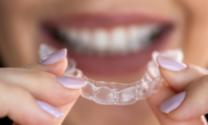 Aligner für schöne Zähne.
