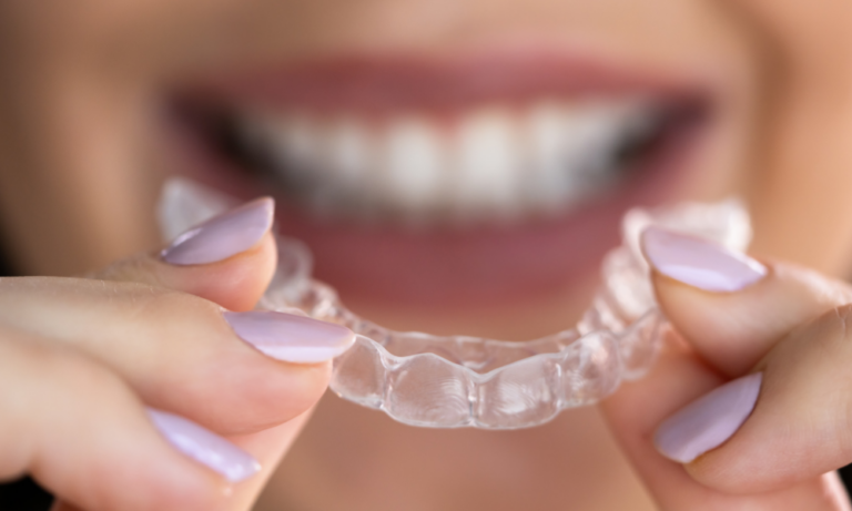 Aligner für schöne Zähne.